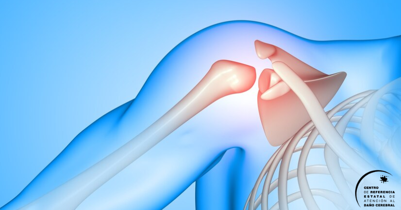 Guía de recomendaciones en el hombro doloroso tras un ictus